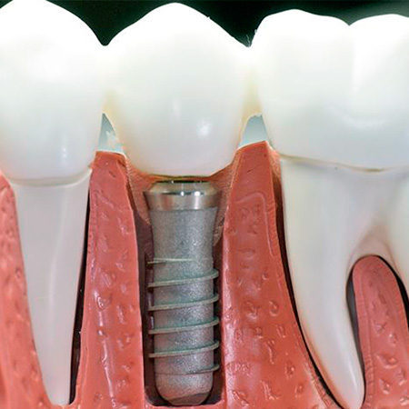 Intensivo de Implantología Oral